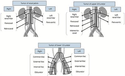 Lymph Node Dissection During Radical Nephro-Ureterectomy for Upper Tract Urothelial Carcinoma: A Review